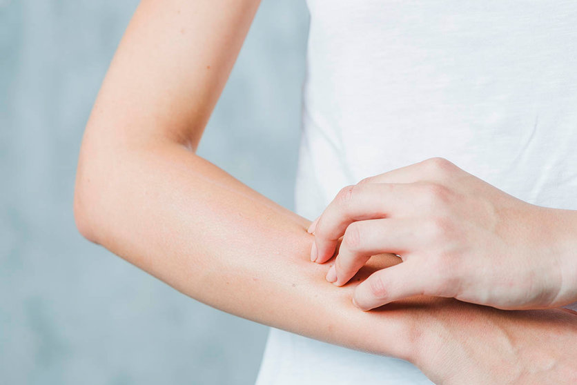 ¿Dermatitis atópica en verano?: Así es cómo puedes tratarla en casa. Foto freepik. 
